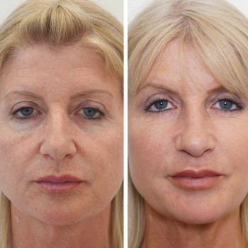 Уколы Botox/Dysport для лица