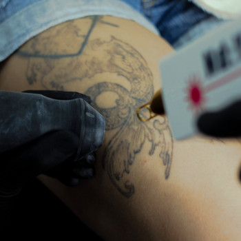 Удаление татуировки