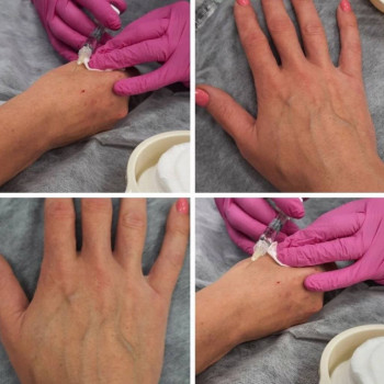 Парафинотерапия рук